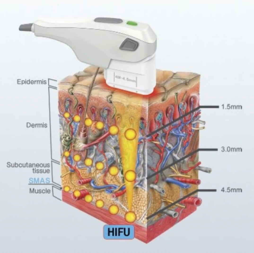 HIFU à Paris - Soin lift anti-relâchement du visage et cou