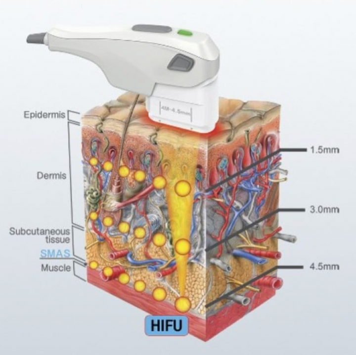HIFU à Paris - Soin lift anti-relâchement du visage et cou